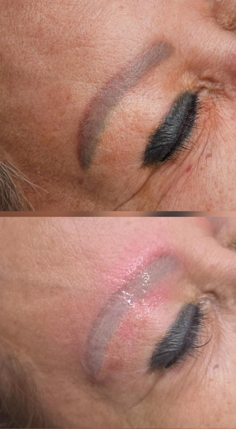 Before and after eyebrow pigment removal by Brenda Cazares in National City, lightening an old gray-toned permanent makeup tattoo.