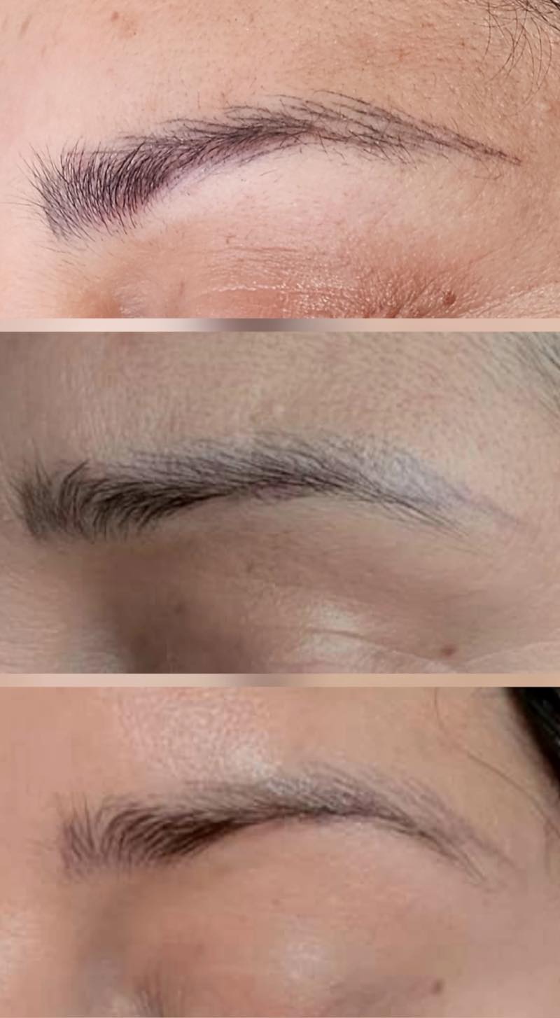 Progressive eyebrow pigment removal sessions by Brenda Cazares in National City, gradually fading previous permanent makeup.