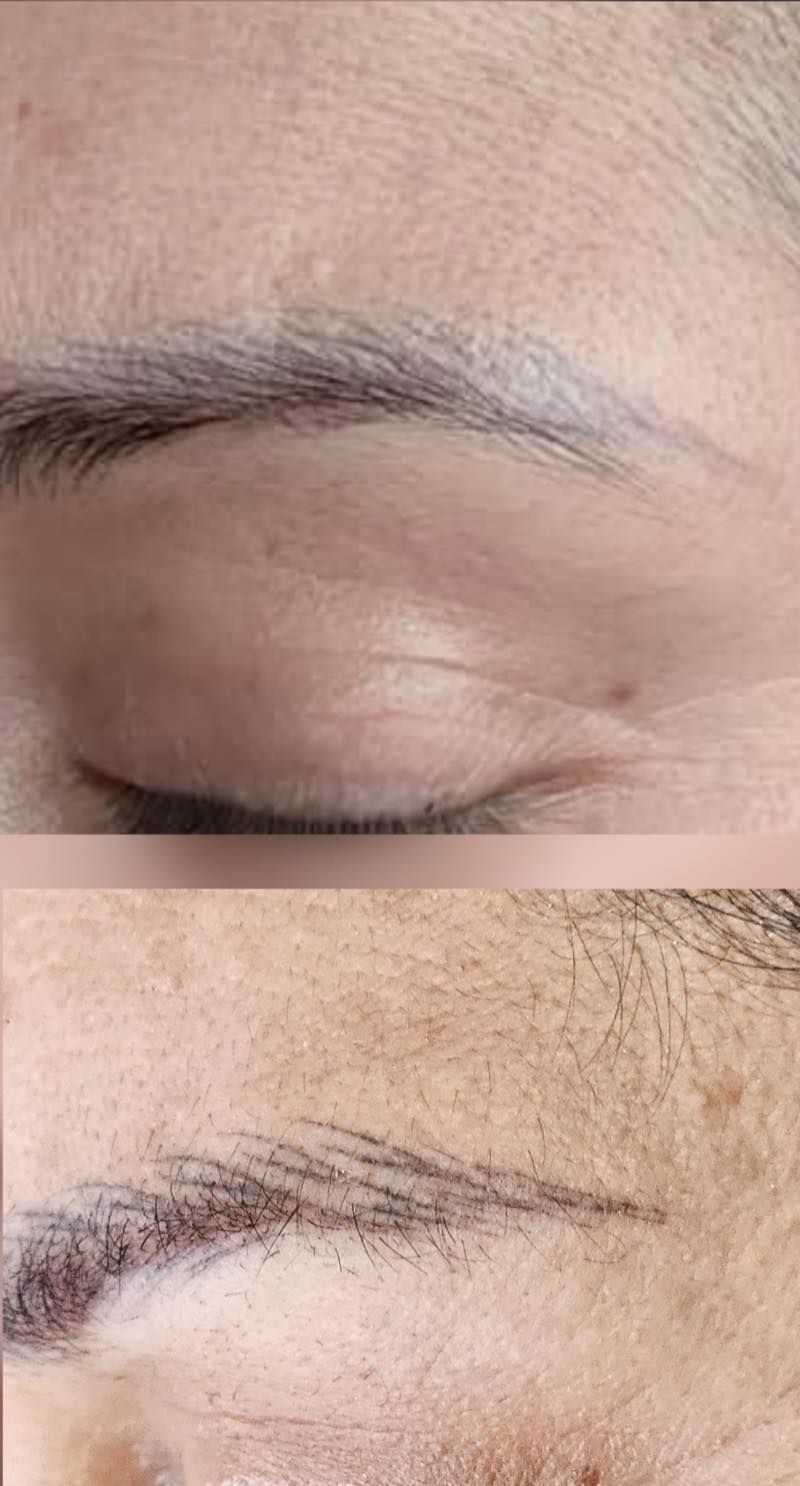 Eyebrow pigment removal results by Brenda Cazares in National City, clearing old permanent makeup to prepare for a new design.